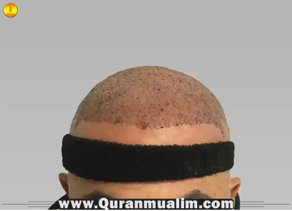 is hair transplant haram, hair transplant is halal or haram,is a hair transplant haram, hair transplant in islam ,are hair transplants haram, is hair transplant halal, hair weaving vs hair transplant