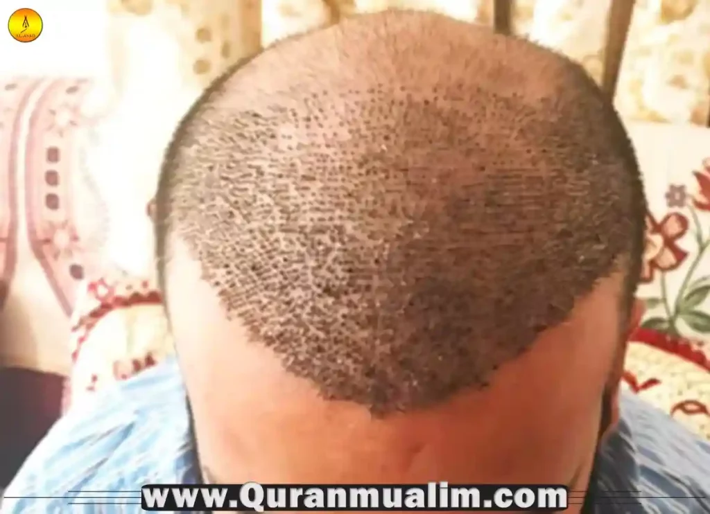 is-hair-transplant-haram-in-islam-quran-mualim