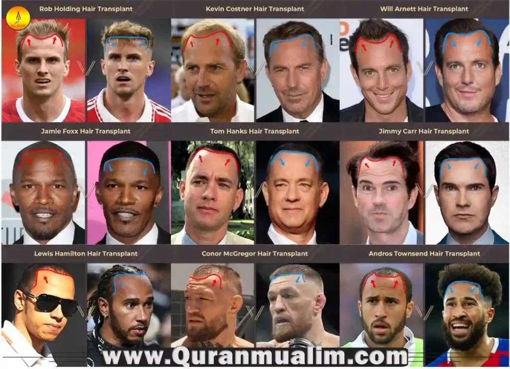 is-hair-transplant-haram-in-islam-quran-mualim