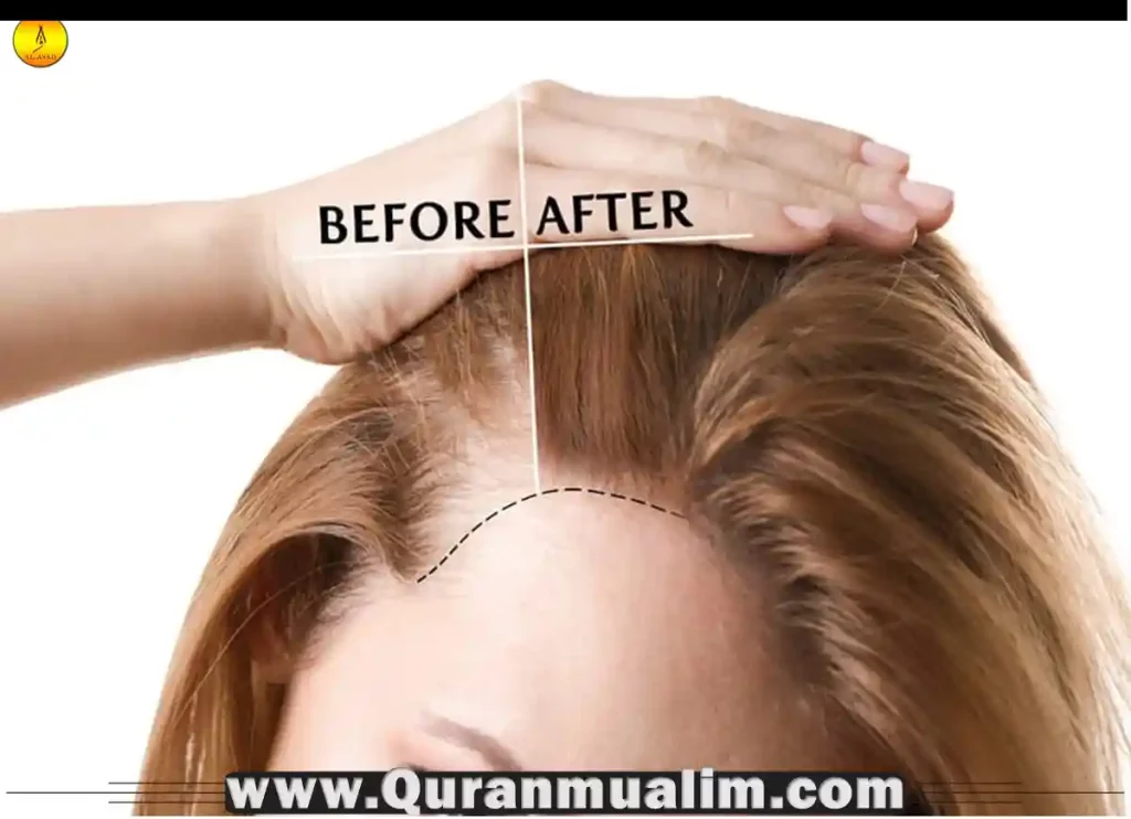 is-hair-transplant-haram-in-islam-quran-mualim